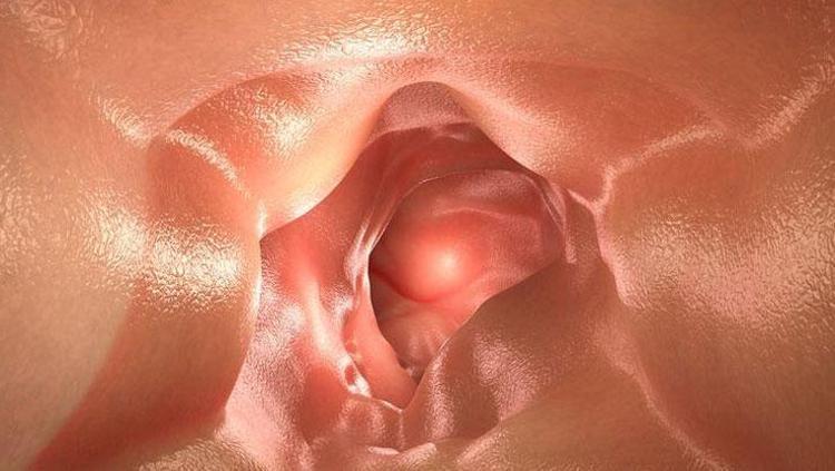 CHRON HASTALIĞIN NEDİR