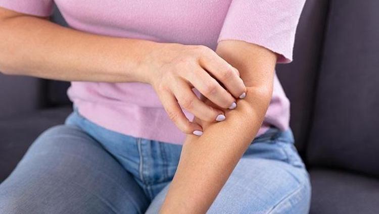 Türk Dermatoloji Derneğinden şaşırtan açıklama: 3 yıl süren uyuz vakaları duyuyoruz