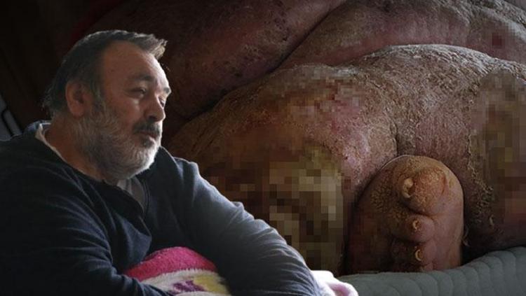 300 kiloluk fil hastasının yardım çığlığı Bu hastalık benimle mezara gitmesin