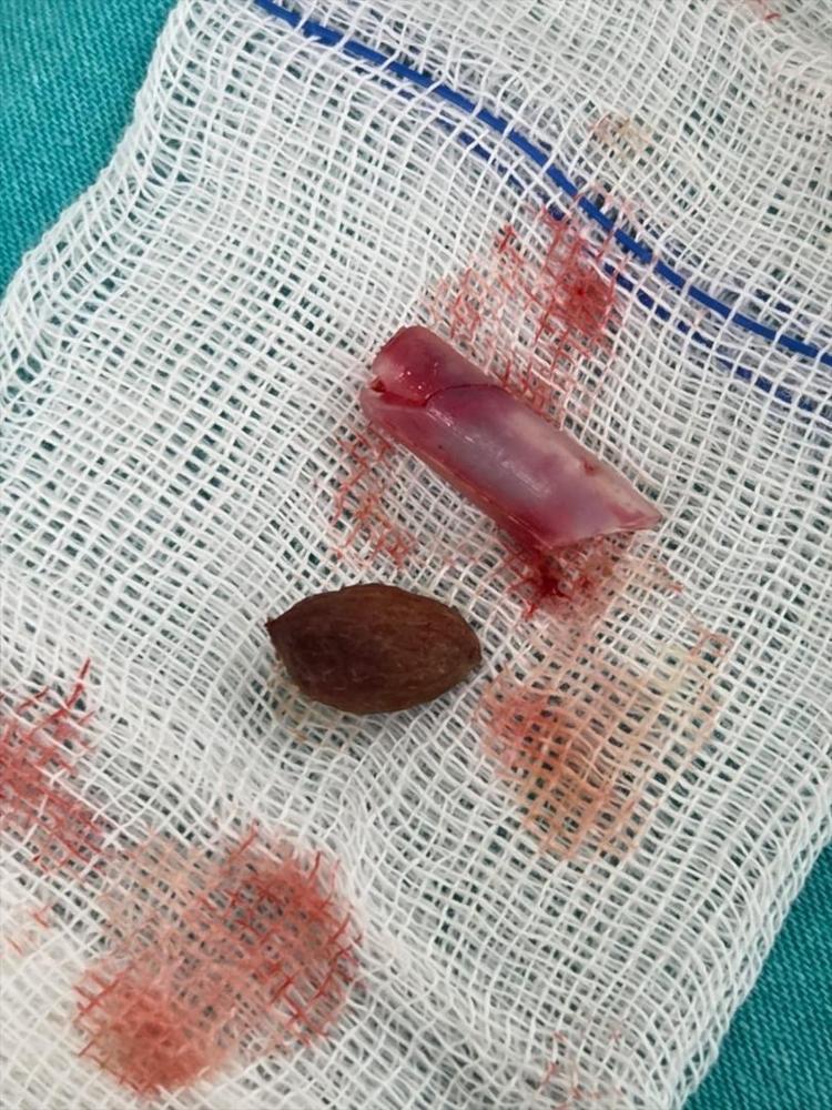 Kaşıntı şikayetiyle gitti ameliyata alındı Burnundan çıkanlara kimse inanamadı