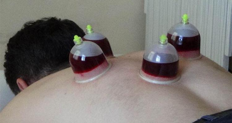 Ocak ayı hacamat günleri nelerdir 2026 Hacamat tarihleri, altın günler ne zaman Ocak ayı hacamat tarihleri