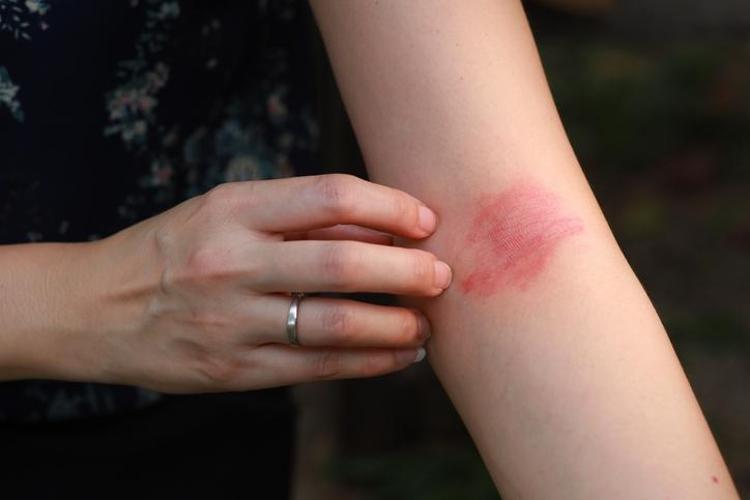 Pul pul dökülmeyi ve kaşıntıyı engelliyor Evde kolayca hazırlanan egzama balsamı tarifi