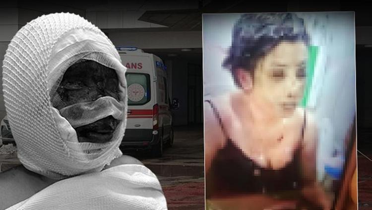 Boşanma aşamasında kezzaplı işkence Koli bandıyla bağlayıp başından aşağı döktü