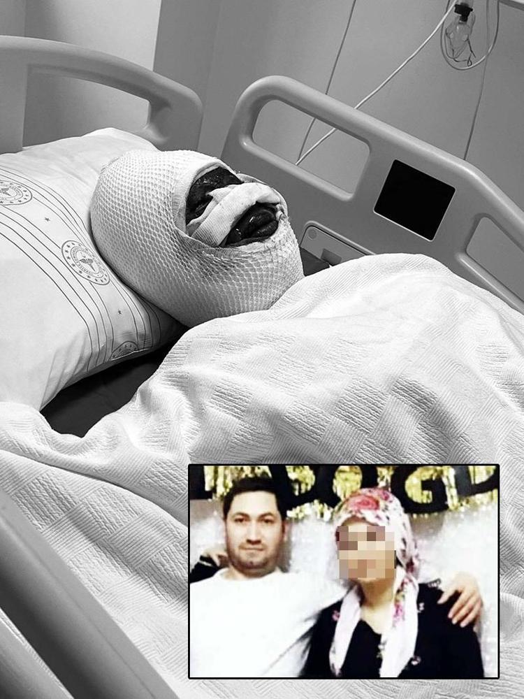 Boşanma aşamasında kezzaplı işkence Koli bandıyla bağlayıp başından aşağı döktü