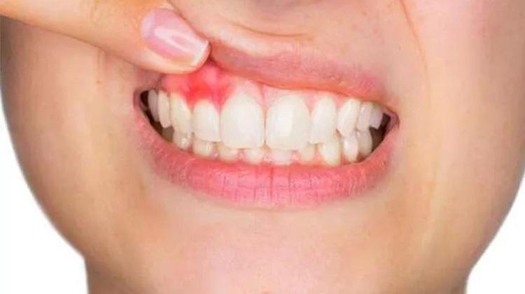 Dişteki çay ve kahve lekesi nasıl çıkar Tek kullanımda etki ediyor: İnci gibi dişlerin sırrı