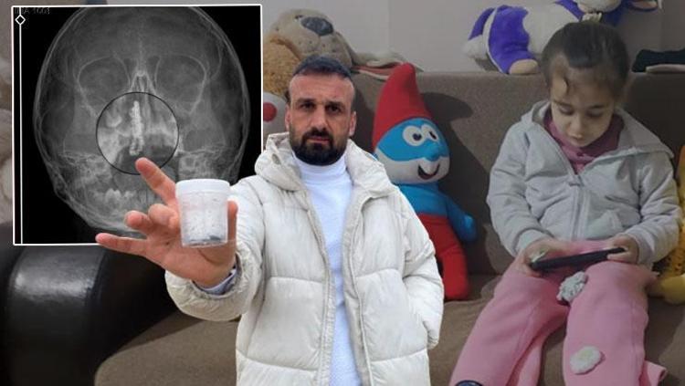 Doktorlar soba isi dedi, ameliyatta çıkan şey şoke etti 2 yıl burnunda onunla yaşamış