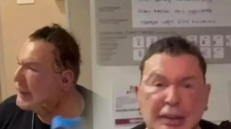 Yüz gerdirme operasyonu olan Kuşum Aydın son halini paylaştı
