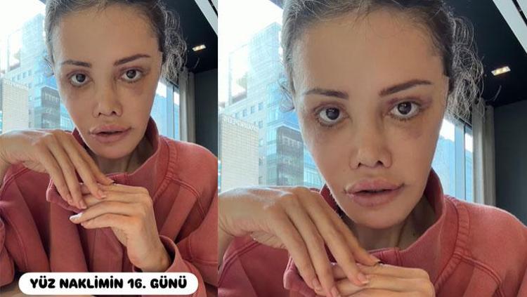 YÜZ GERME, GÖZ BÜYÜTME, LİFTİNG