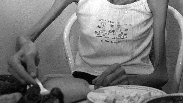 Bozuk süt sandı, acı gerçek 25 kiloya düşünce ortaya çıktı Doktorlar durumunu zorunlu anoreksiya olarak tanımlıyor