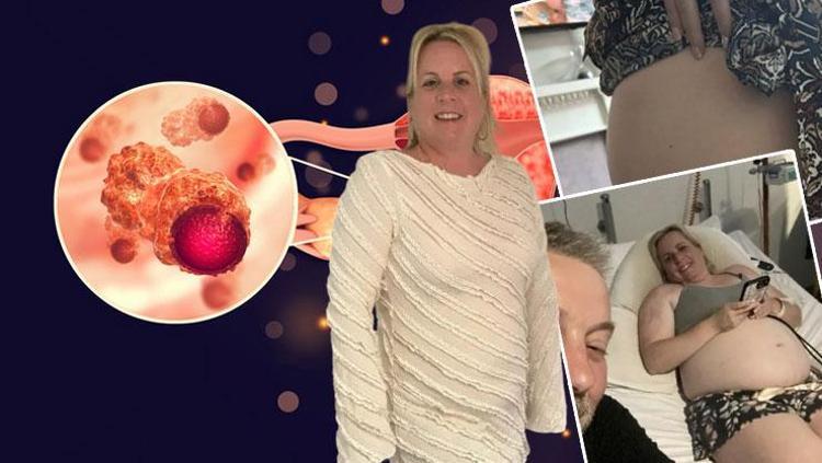 Sadece fazla kilo aldığını düşünüyordu 39 yaşındaki kadını şok eden kanser teşhisi: Bu belirti herkesin gözünden kaçıyor