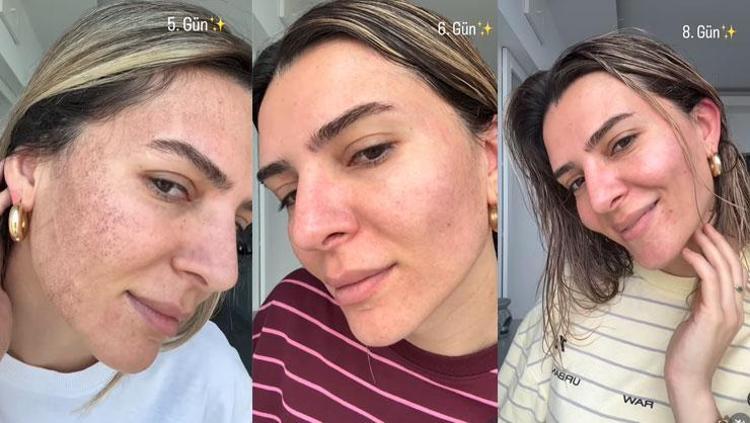 Survivor Merve Aydının yüzüne yaptırdığı işlem şoke etti İşte son hali