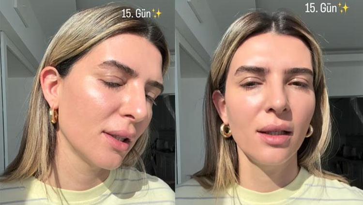 Survivor Merve Aydının yüzüne yaptırdığı işlem şoke etti İşte son hali