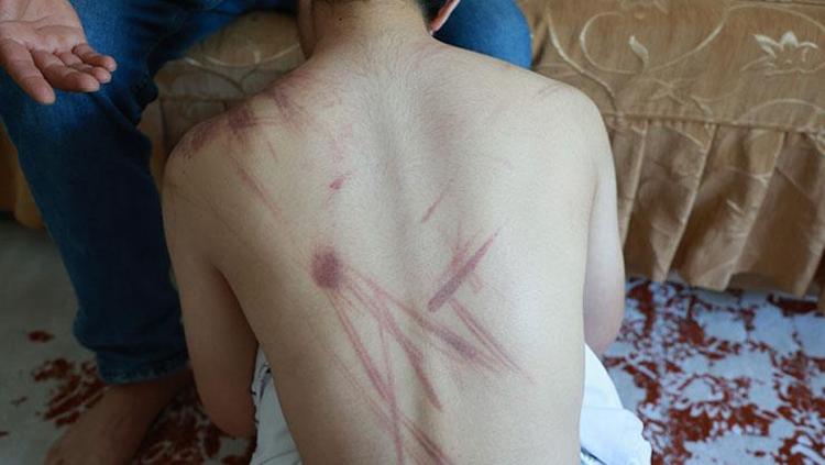 Bunu yapanlar insan olamaz Rehabilitasyon merkezinde şiddet iddiası: Vücudundaki izler şoke etti