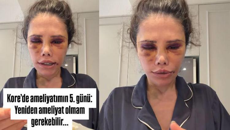 BİR AMELİYAT DAHA OLACAK