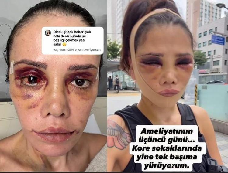 Yüz nakli olmuştu Didem Ceran: Beni CİMERe şikayet ediyorlar