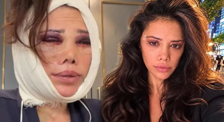 İki kez yüzünü gerdiren Didem Cerandan estetik açıklaması Kim Kardashian yöntemleri uygulanacak