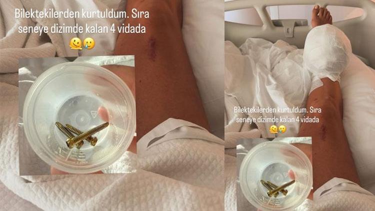 BİLEĞİNDEN ÇIKARILAN VİDALARI GÖSTERDİ