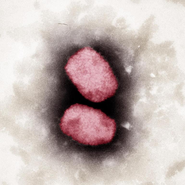 Maymun çiçeği virüsü 76 gün boyunca vücuttan atılmadı