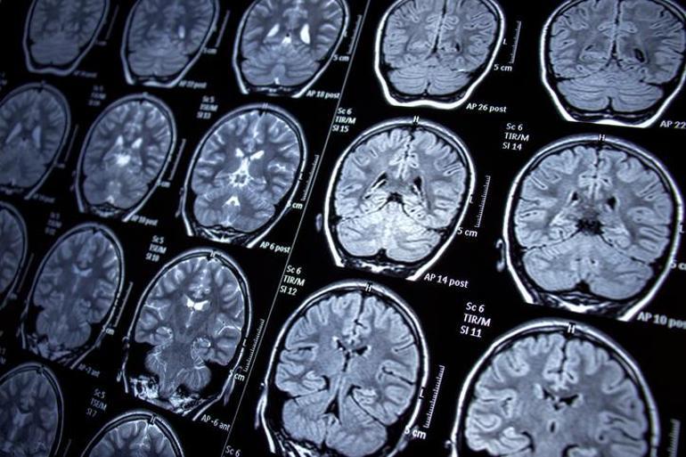 Aynı okuldan 100den fazla kişi beyin kanserine yakalandı: Araştırmada şaşırtıcı sonuç