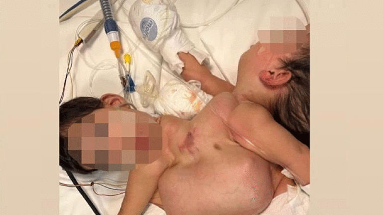 Siyam ikizleri Cezayirli bebekler İstanbulda 9 saat süren ameliyat ile ayrıldı