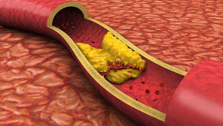 HDL kolesterol yüksekliği nedir, neden olur HDL kolesterol yüksekliği kaç olmalıdır