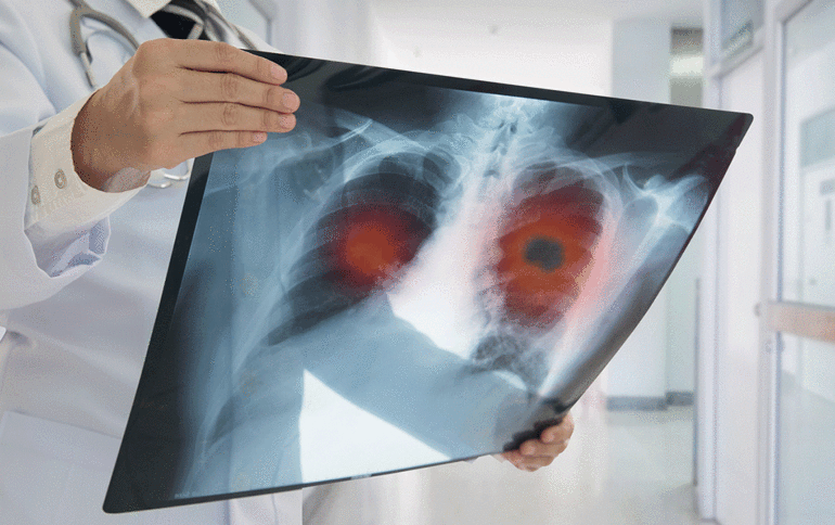 Akciğer kanserinin en sık görülen belirtisi: Hemoptizi