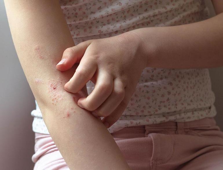 Çocuklarda glüten alerjisi belirtileri