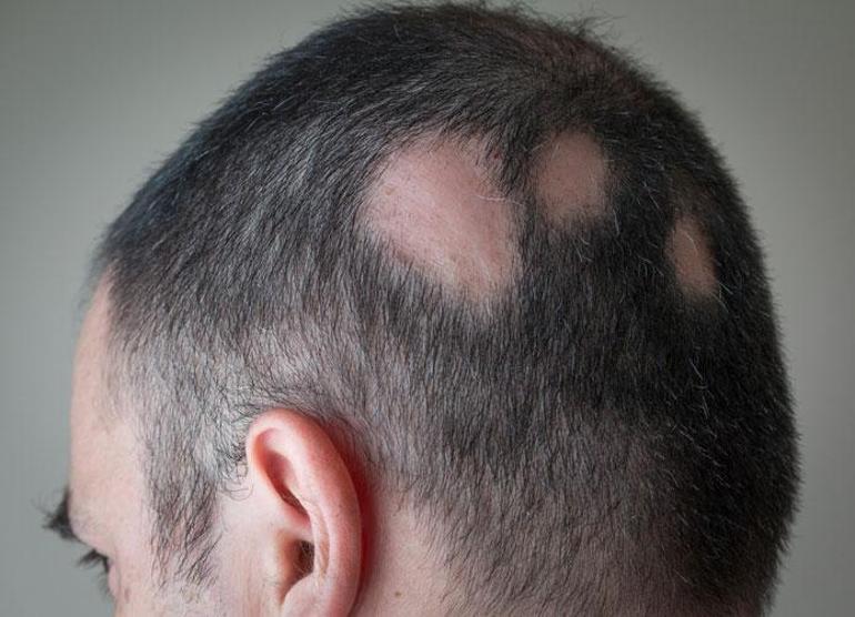 Toplumun yaygın hastalığı: Saç dökülmesi ile aniden ortaya çıkıyor