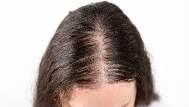 Saç yağlanması nasıl önlenebilir İşte bazı doğal öneriler...