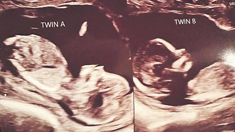 İki rahimde iki bebek taşıyor