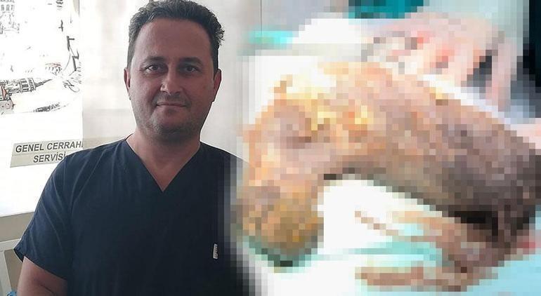 Doktorlar şoke oldu Midesinden 50 santim uzunluğunda saç yumağı çıktı