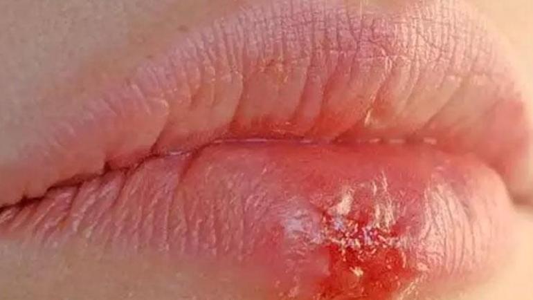Küçük bir öpücük ışığını söndürdü Korneası delindi ve gözü işlevini yitirdi