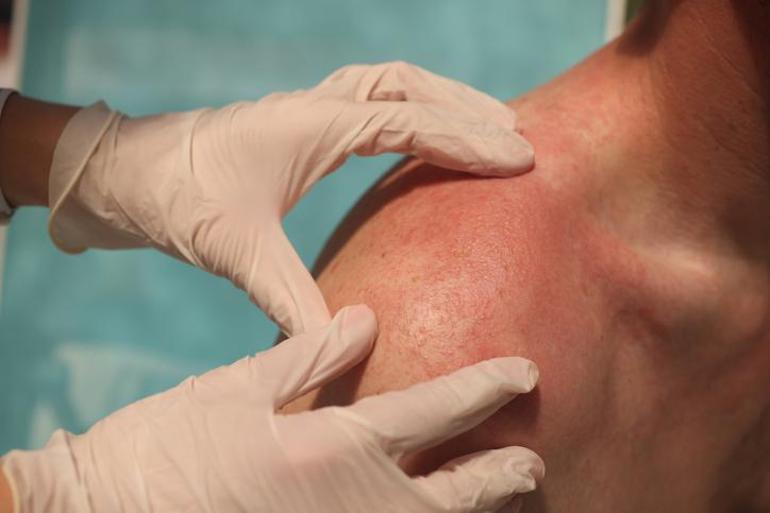 Güneş yanığına ilk müdahaleye dikkat Dermatologdan hayat kurtaran uyarılar