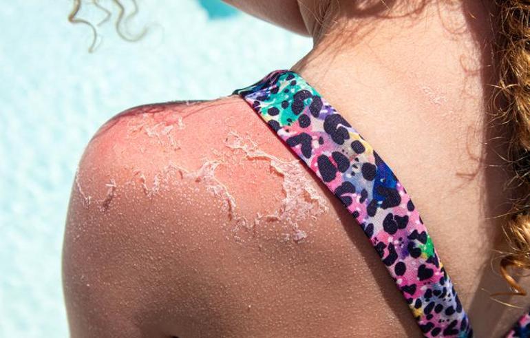 Güneş yanığına ilk müdahaleye dikkat Dermatologdan hayat kurtaran uyarılar