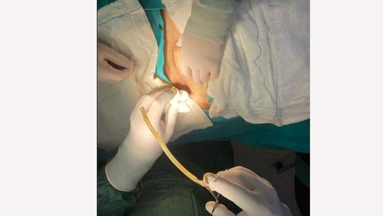 Doğum yapan kadının karnında 15 cmlik hortum unuttular Doktorun skandal savunması şoke etti