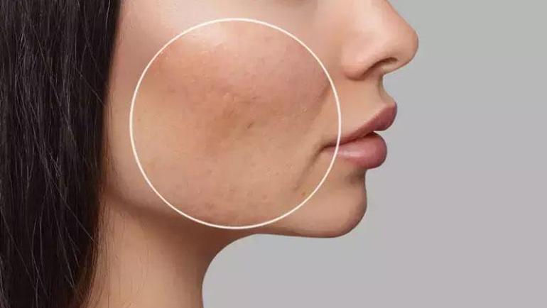 Kolajen sentezi yüzde 15 azalıyor Derin uyku yoksa derin çizgiler var