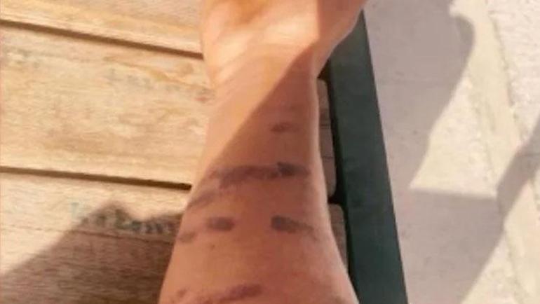 Lazer epilasyon 23 yaşındaki adamın kabusu oldu Ben yandım başkaları yanmasın diye isyan etti