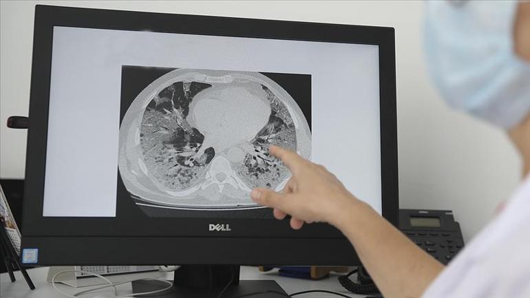 Uzmanı uyardı: Zatürre ölümünüze neden olabilir