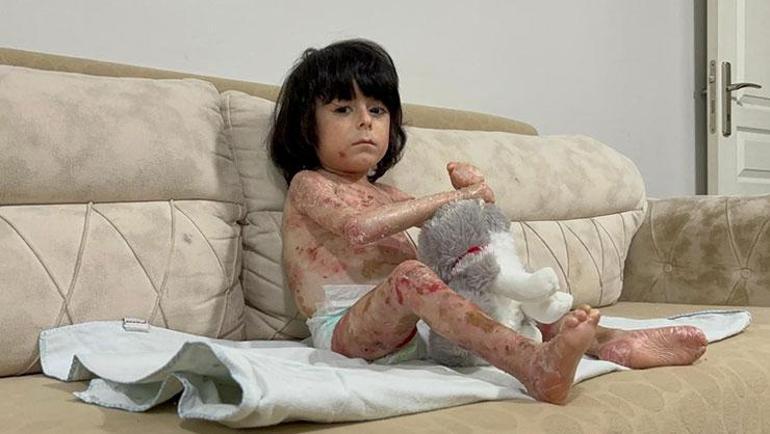 Vücudunu kaplayan yaralar yüzünden kıyafet giyemiyor 4 yaşındaki İbrahimin yürek yakan çaresizliği