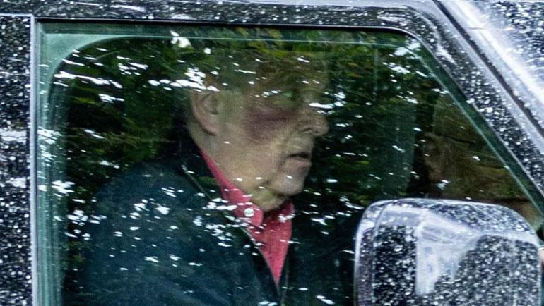 Epstein bağlantısı ortaya çıkmıştı Eski prens Andrewin yüzündeki gizemli morluk