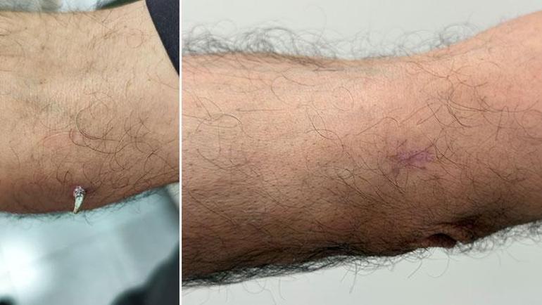 Dirseğinde küçük bir yara sandı… Gerçek bambaşka çıktı: Geçmeyen yaraları ihmal etmeyin