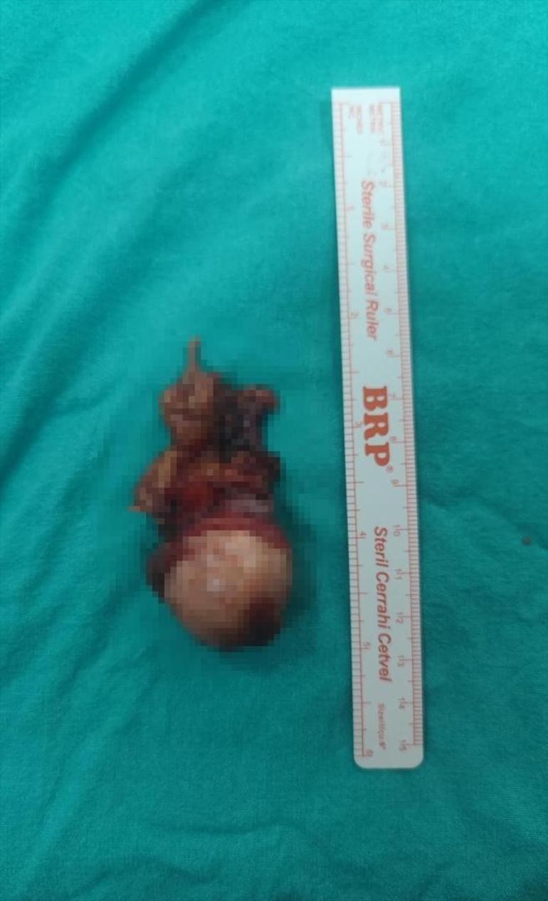 Diyaliz riski taşıyordu Çifte ameliyatla sağlığına kavuştu