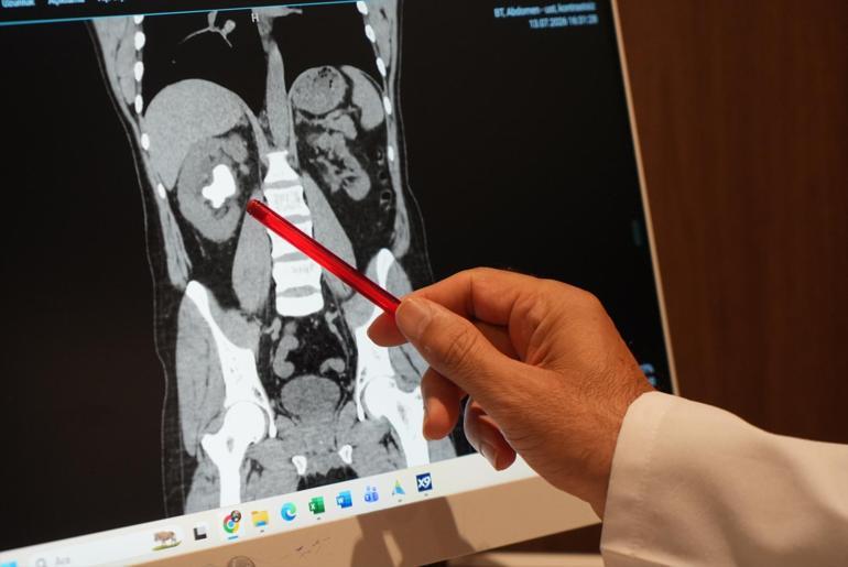Böbreğinden 25 santimetreküplük taş çıkarıldı Hiç ağrı hissetmeden yıllarca taşımış